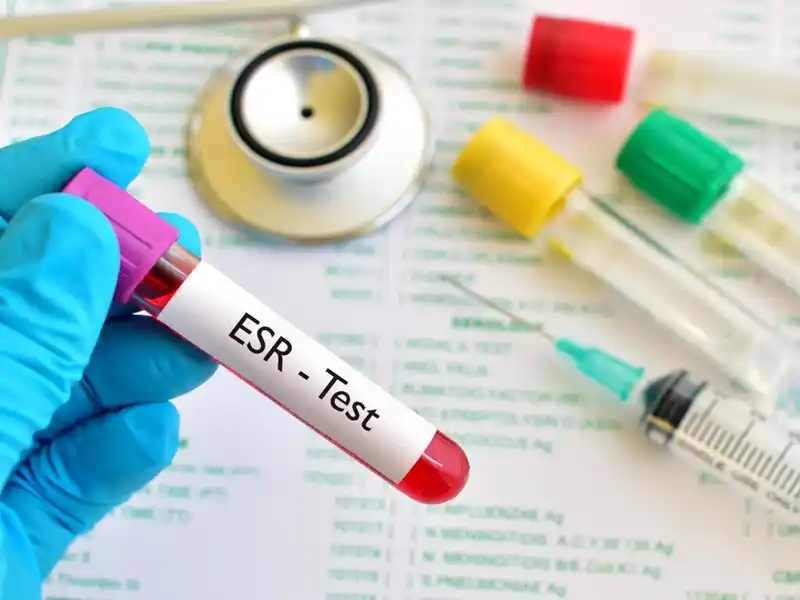آزمایش esr چیست؟