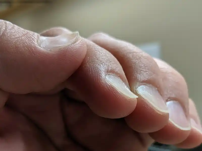 اثرات کم خونی بر ناخن ها
