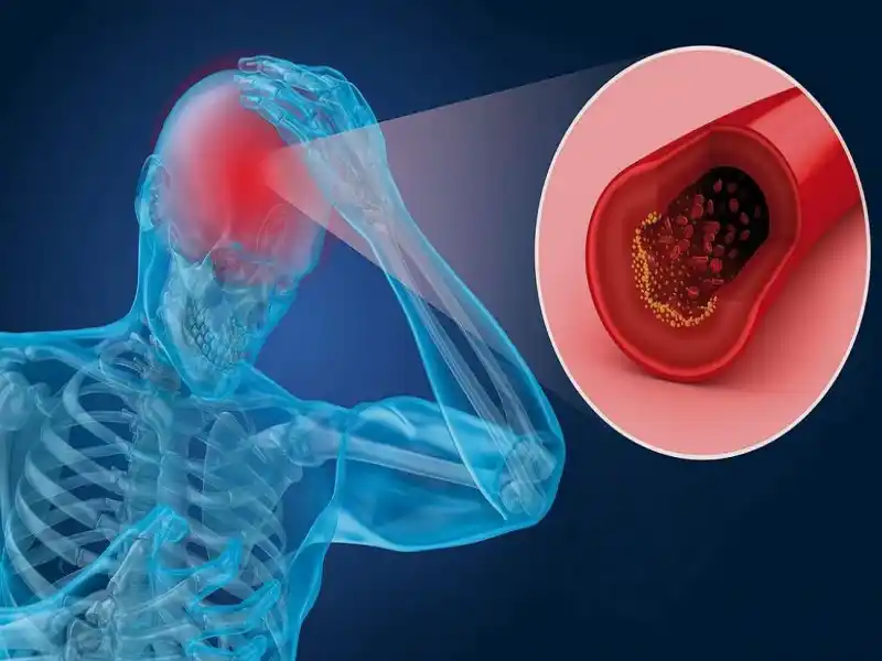 آیا استرس باعث غلظت خون میشود؟