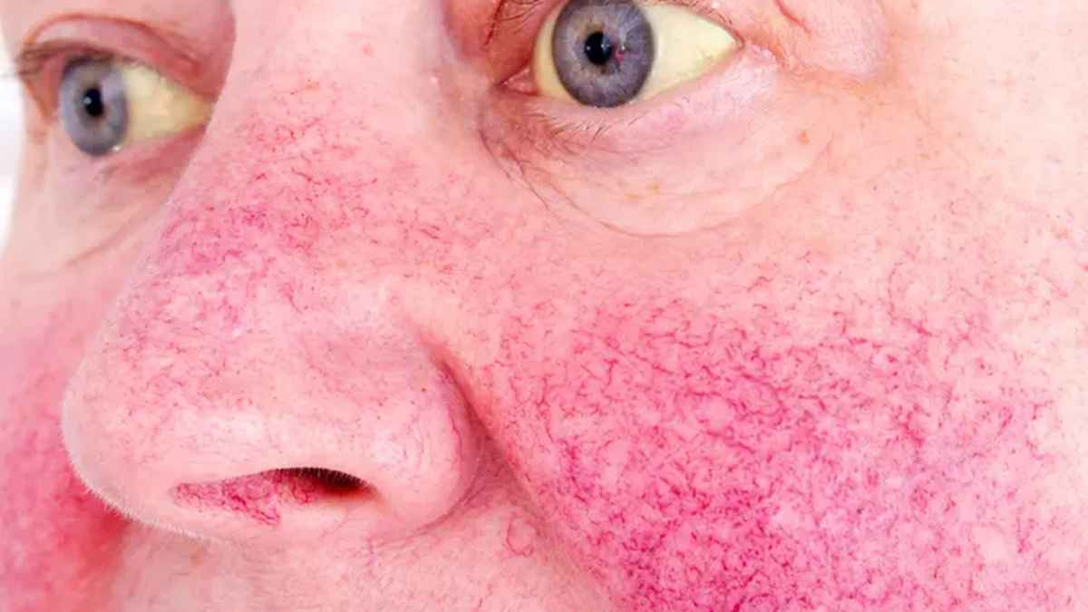 نشانه های کبد چرب در صورت