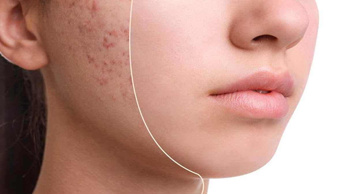 چگونه علائم کبد چرب را در صورت خود درمان کنیم؟