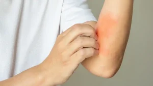 تاثیر کم خونی بر پوست
