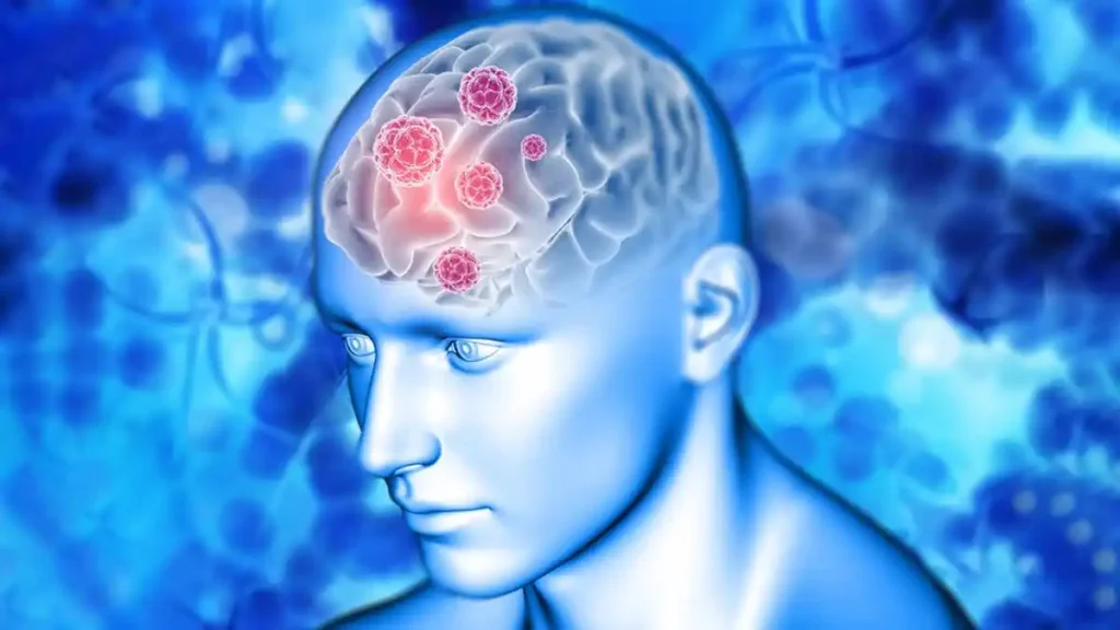 لخته شدن خون در مغز
