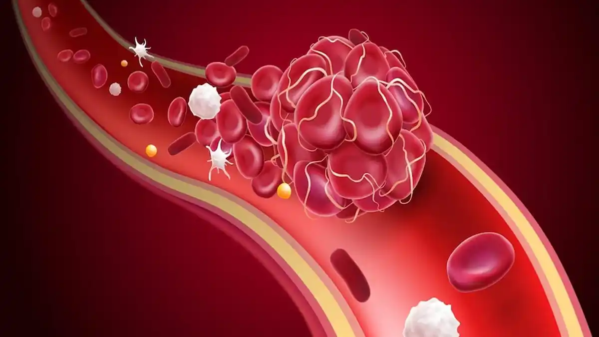لخته شدن خون در مغز چیست؟