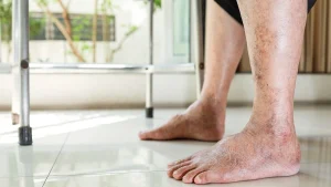 خطرات گردش خون ضعیف در پاها