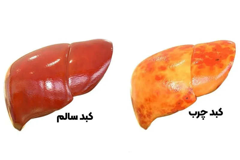 کبد چرب چیست