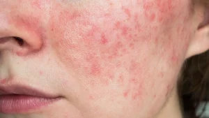 بررسی عوارض استروئید بر پوست